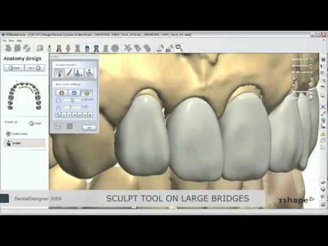 CAD CAM Zirconium bridge Dentist Willemsens Johan