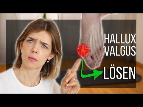 Hoe hallux valgus te stoppen (en te voorkomen dat het erger wordt)