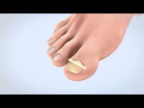 Nailner Anti Nagelpilz Behandlung mit Pinsel oder als Stift - Second Medium