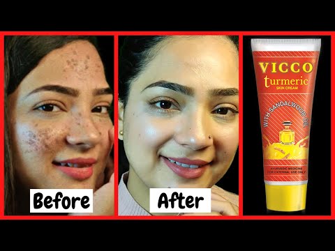WORK FOR PIMPLES..? Vicco turmeric ayurvedic cream | Full review,Uses,benefits,Side effects