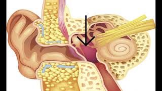 Download lagu Aero-otitis media: Why Ear Gets Blocked during Air Travel, Prevention, Treatment mp3 Download lagu Aero-otitis media: Why Ear Gets Blocked during Air Travel, Prevention, Treatment mp3