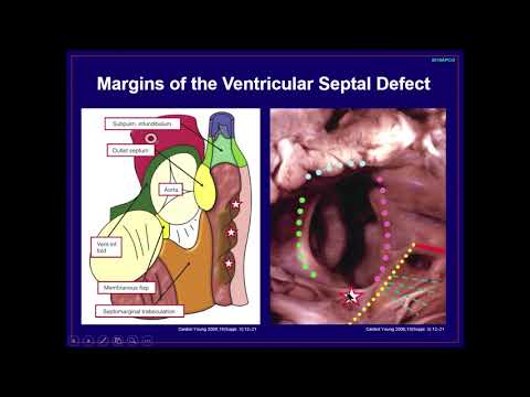 Morphology and treatment of TOF