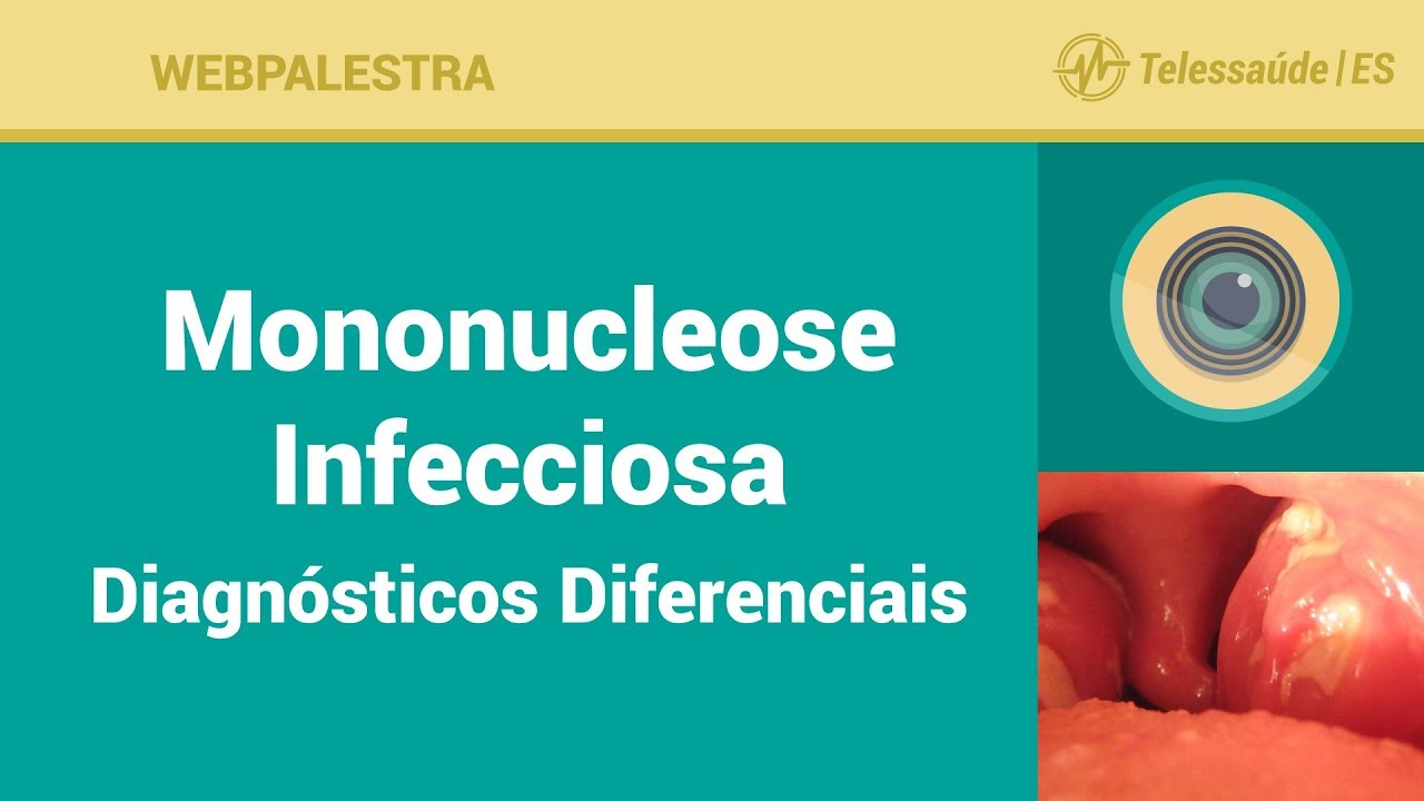 WebPalestra: Mononucleose Infecciosa Diagnósticos Diferenciais