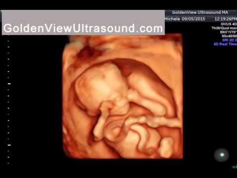 HDLive Ultrasound 15 weeks Boston