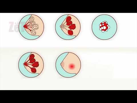 Kanceri i gjirit   si të ruhemi  - "Kuriozitete e këshilla mbi shëndetin"