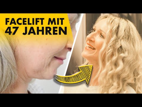 Nachkontrolle 4 Monate nach Facelift! | Dr. Jungwirth