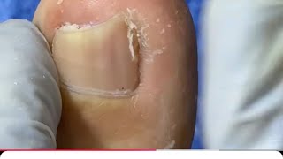 Ep_8693 Foot nails skin removal 👣 เล็บเคยหลุดมาประมาณ 10 ปี ค่ะ 😅 (clip from Thailand)