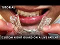 A Tutorial On How To Make A Custom Night Guard On A Live Patient