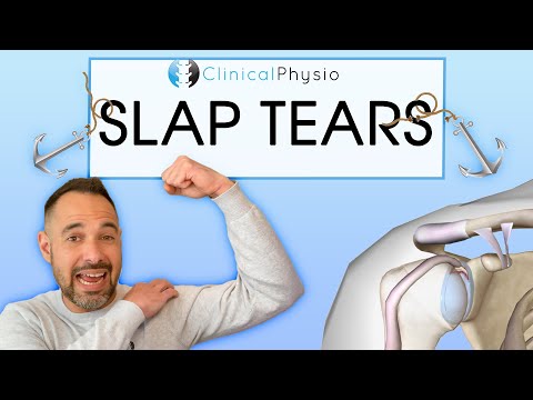 SLAP-Läsionen (Superior Labral Anterior Posterior) | Alles, was Sie über SLAP-Läsionen wissen müs...