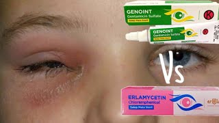 Download lagu Differences between Gentamicin Eye Ointment and Chloramphenicol Eye Ointment #eyeointment #eyemed... mp3