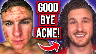 9 Ways To Get Rid of Your Acne (EASY, MEDIUM & HARD)