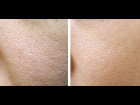 download lagu mp3 mp4 Tips Merawat Wajah Rusak, download lagu Tips Merawat Wajah Rusak gratis, unduh video klip Tips Merawat Wajah Rusak