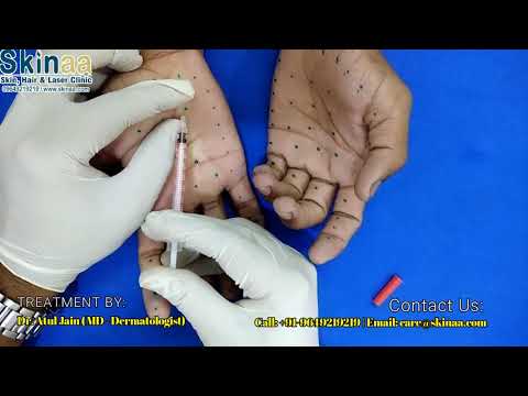 Botox Therapy for Palmer Hyperhidrosis (Sweaty Hands) | Skinaa Clinic, Jaipur