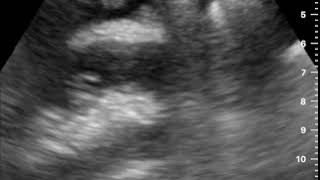 Free Fluid Left Upper Quadrant LUQ: Captured with Butterfly iQ™