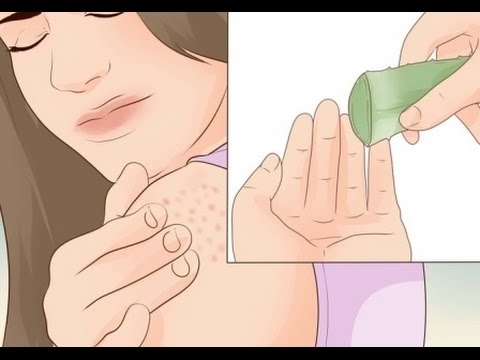 Leczema su una palma con che spalmare È possibile spalmare la psoriasi scarlatta