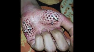 BIG ACNE CYST IN THE HAND cyst big acne worms in hend big botfly miasis crvi u koži