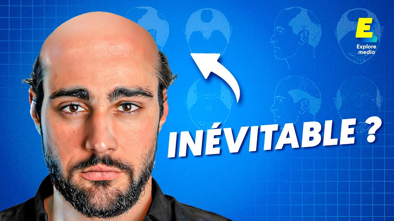 Pourquoi les hommes perdent leurs cheveux ?
