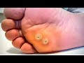 How To Remove a Foot Corn or Callus [Foot Doctor Home Treatment]