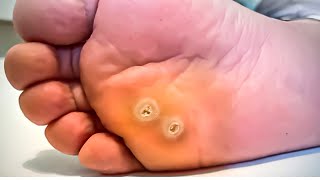 How To Remove a Foot Corn or Callus [Foot Doctor Home Treatment]