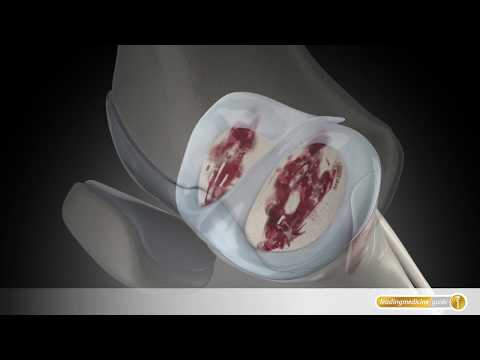 Osteochondrose der Halswirbelsäule während der Schwangerschaft Herniation der Bandscheibe Herniation para