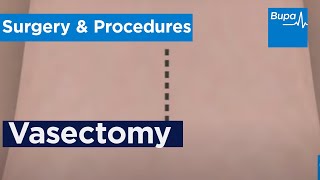 Vasectomy Health Information Bupa Uk Vasectomy Health Information Bupa Uk