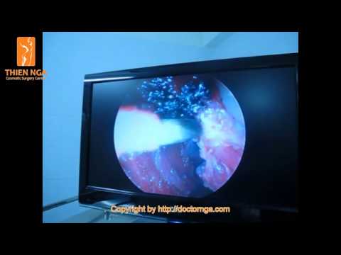 Nâng Mông- Phẫu Thuật Nâng Mông-Buttock augmentation-Augmentation des fesses