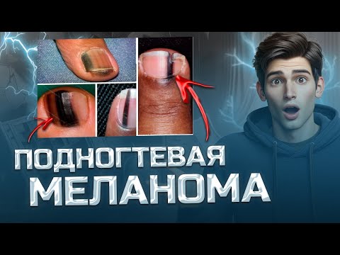 Пятна на ногтях? Что это может быть? Подногтевая меланома ? 😱