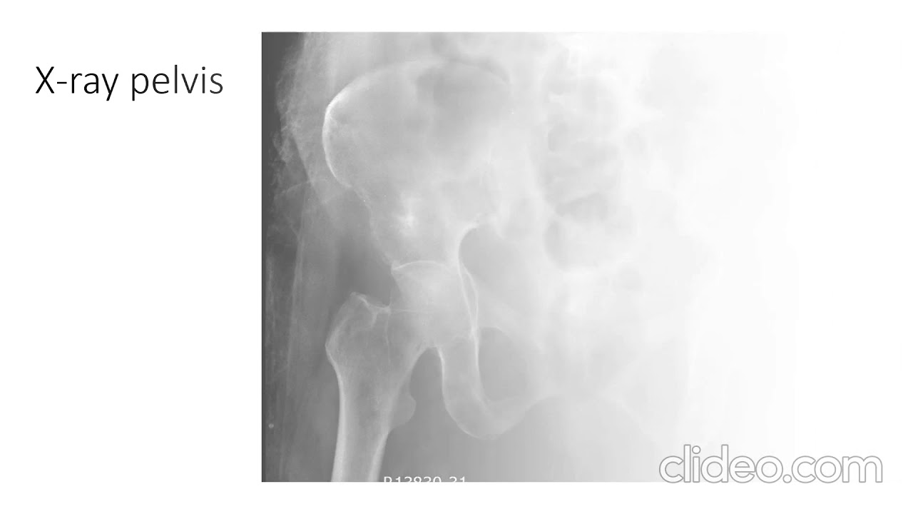 Percutaneous Cement Acetabuloplasty (Way To Heal)