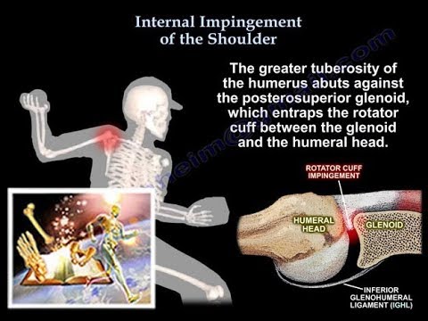 Internal Impingement  of the shoulder- Everything You Need To Know - Dr. Nabil Ebraheim