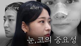 이렇게 달라진다구?! 눈성형&코성형으로 인상 바꾸기 [자연유착+무보형물코끝성형+메부리코성형]