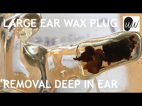 download lagu mp3 mp4 Advance 616 Hearing Aid, download lagu Advance 616 Hearing Aid gratis, unduh video klip Advance 616 Hearing Aid