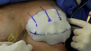 Treatment of Capsular Contracture with ADM; Inframammary Incision Approach