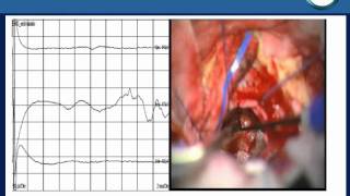 neurorgs.net--neurinoma-del-acustico