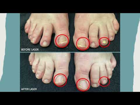 Authentic Results: Using Cutera Laser to Cure Fungal Toenails