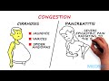 Splenomegaly: Remember the 3 primary causes with CIP
