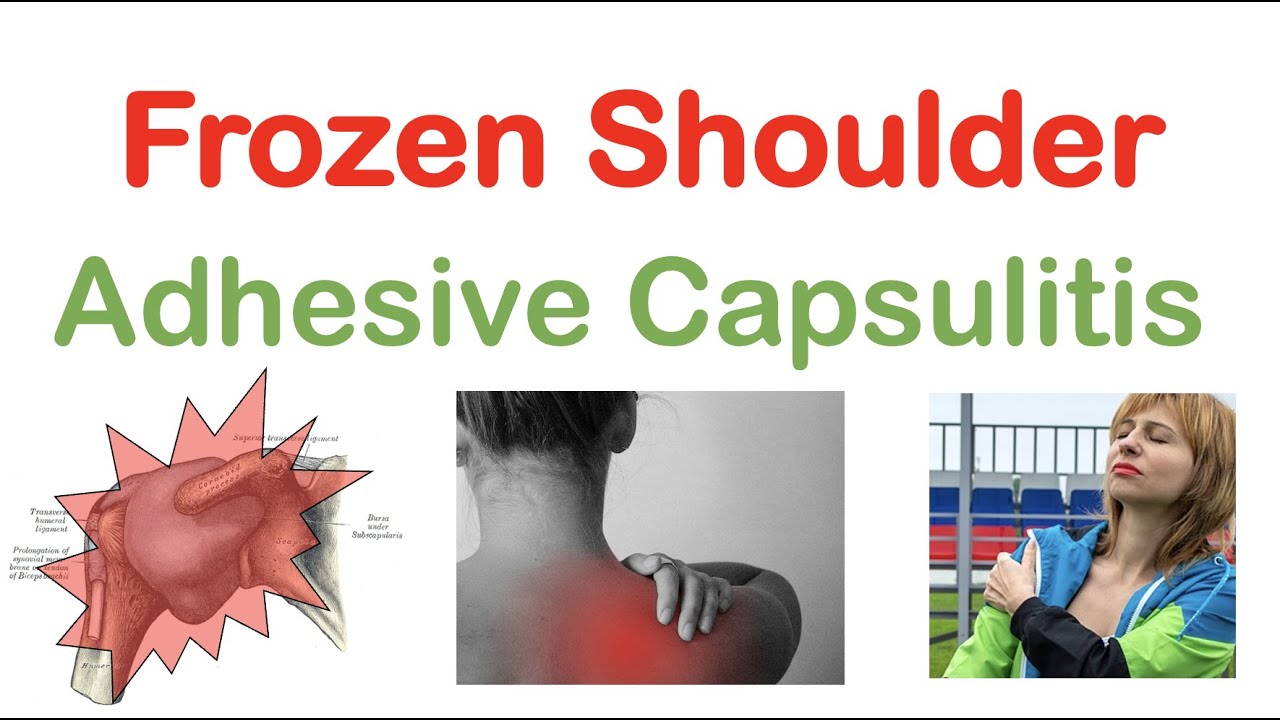 Frozen Shoulder (Adhesive Capsulitis): Causes, Symptoms, Stages, Diagnosis, Treatment