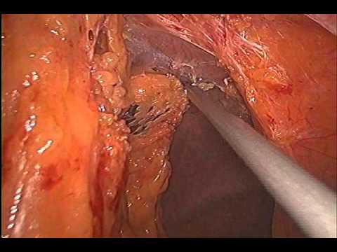 Laparoskopowa hernioplastyka IPOM