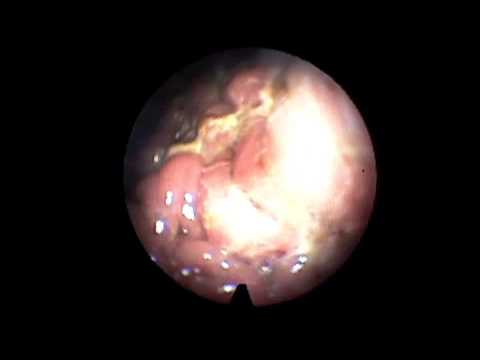 Esophagoscopy as a Diagnostic Method for Candidiasis