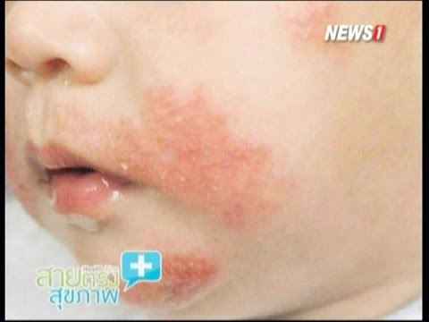 ถาดจาก celandine จากกลาก ครีมสำหรับภูมิแพ้ neurodermatitis