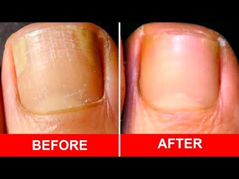Sakit sa pagitan ng mga daliri sa paa halamang-singaw Fungus skin treatment