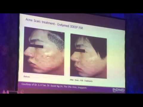 Optimal treatment of acne scars in asian and dark skin types