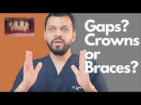 Treatment Options for Gaps Between Front Teeth