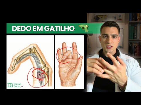 Trigger Finger: What it is, why it happens (Anatomy), and how to treat it!