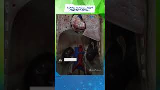 Kasus Penyakit Ginjal di Singapura Meningkat, Ini Tanda-tanda yang Tak Disadari