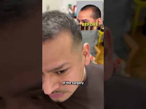 What It's Like To Get A Hair Transplant With Doctor Gary Linkov