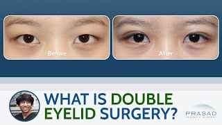 What is Double Eyelid Surgery (Asian Blepharoplasty)?