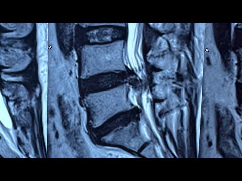 Lumbar Spine disc prolapse :Is cure possible? What is treatment | Dr. Ajay Kothari