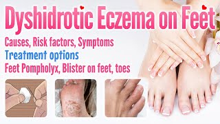 Dyshidrotic eczema on feet causes, symptoms, risk factors, treatment options, Feet pompholyx blister