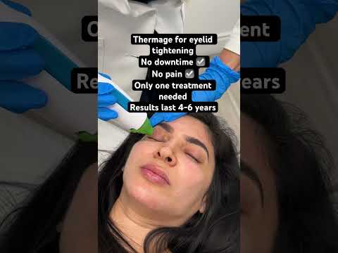 EYELID TIGHTENING #thermage #over40 #antiaging