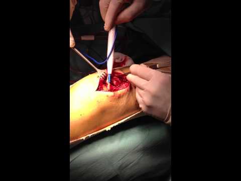 comment soulager syndrome de morton